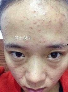 痘痘的照片,痘痘成因解析与改善策略